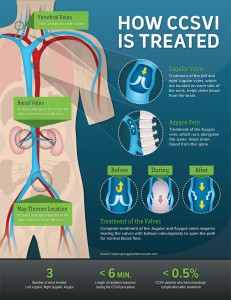 How CCSVI Is Treated